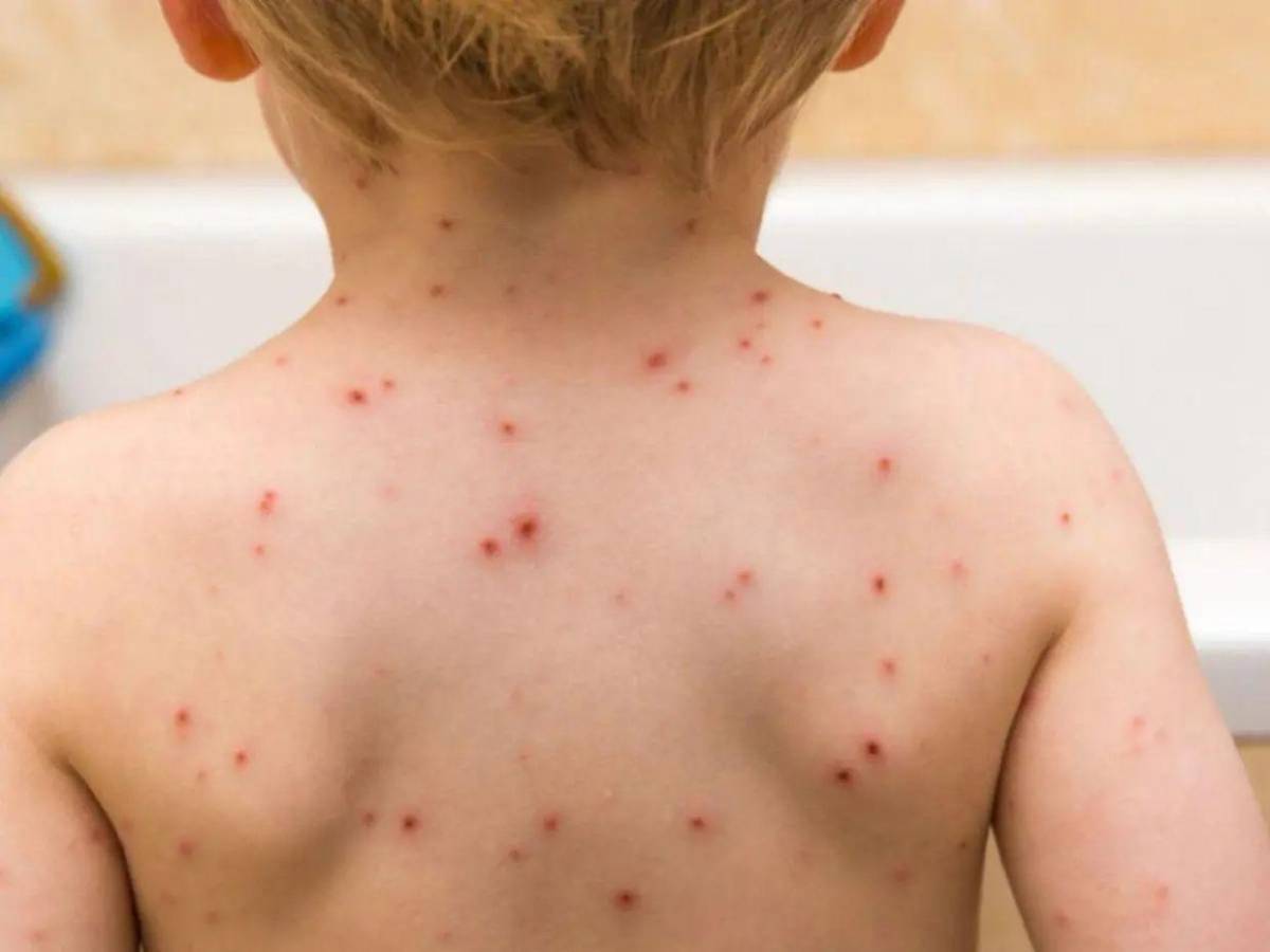 “Altamente contagiosa”: Riesgos de que vuelva el sarampión a Honduras, tras 29 años sin contagios