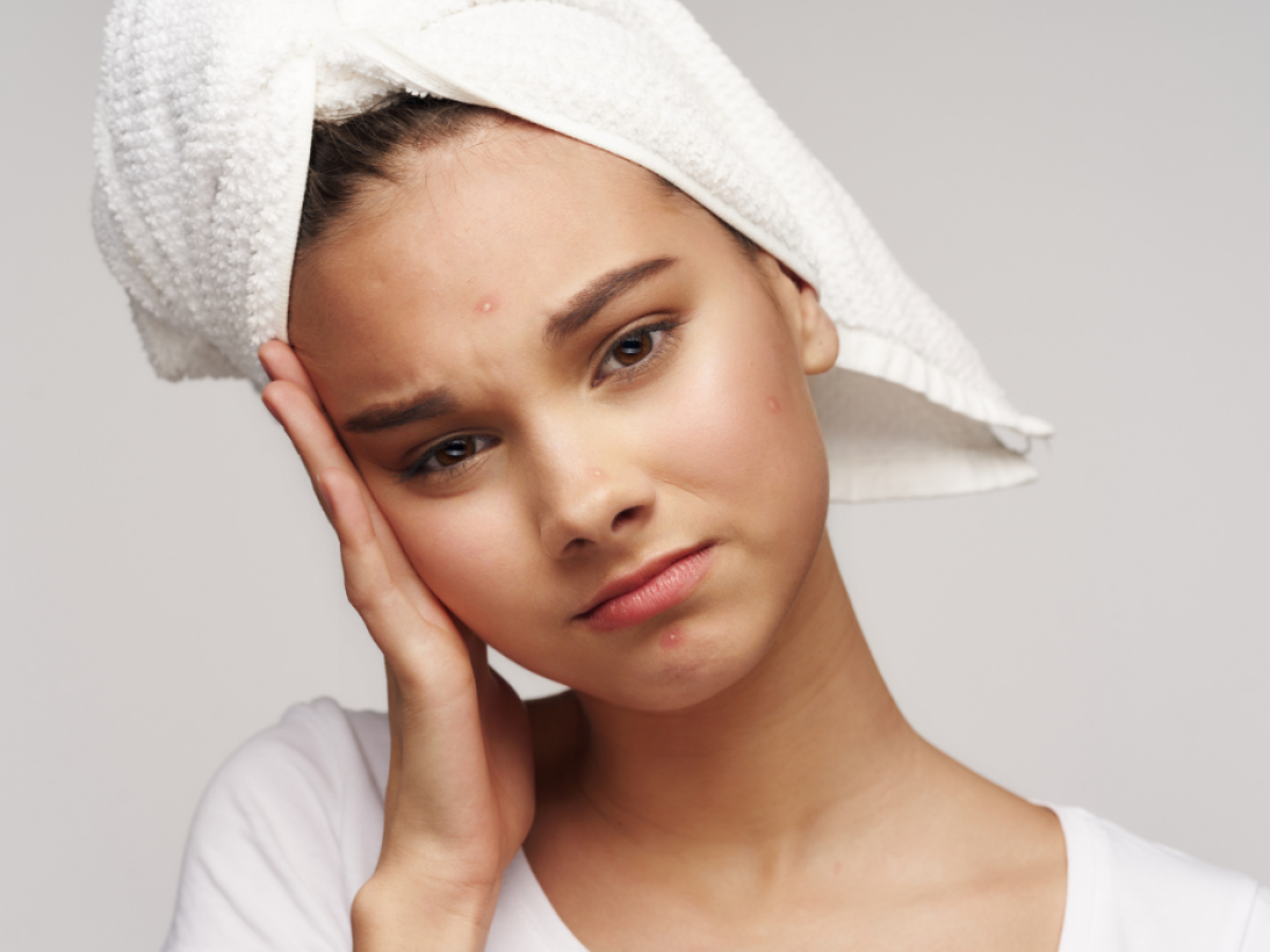 3 claves para combatir el acne de manera segura y eficaz