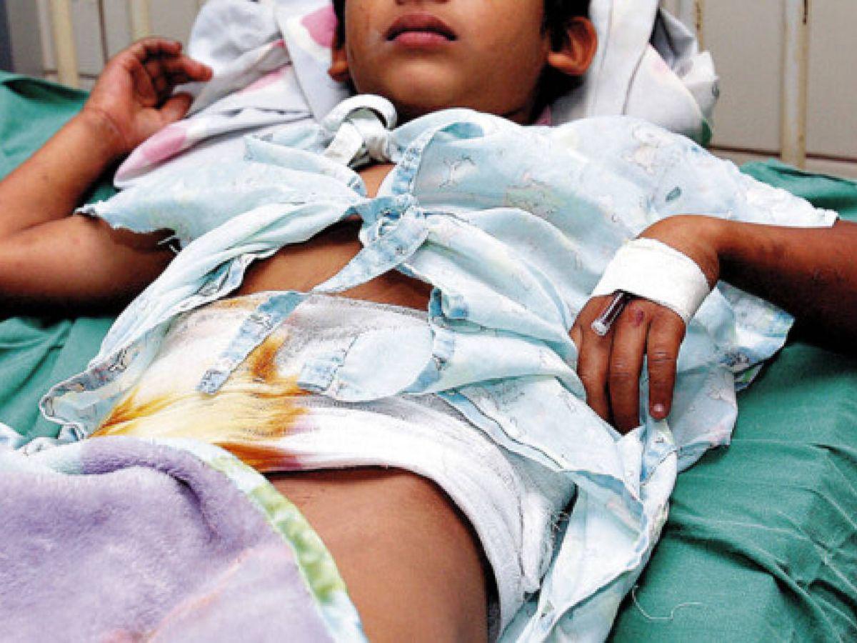 Niños quemados aumentaron en un 22% este 2023 en Honduras