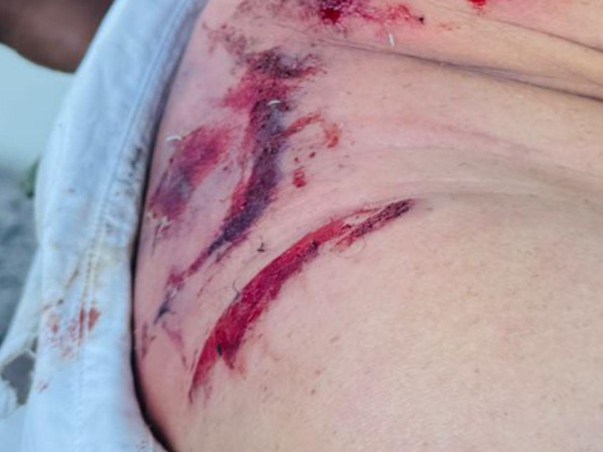 Daño auditivo y posibles quemaduras de tercer grado: estado de salud de la diputada Gladis López