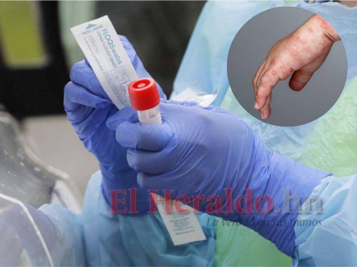 Investigan seis casos sospechosos de viruela del mono en San Pedro Sula