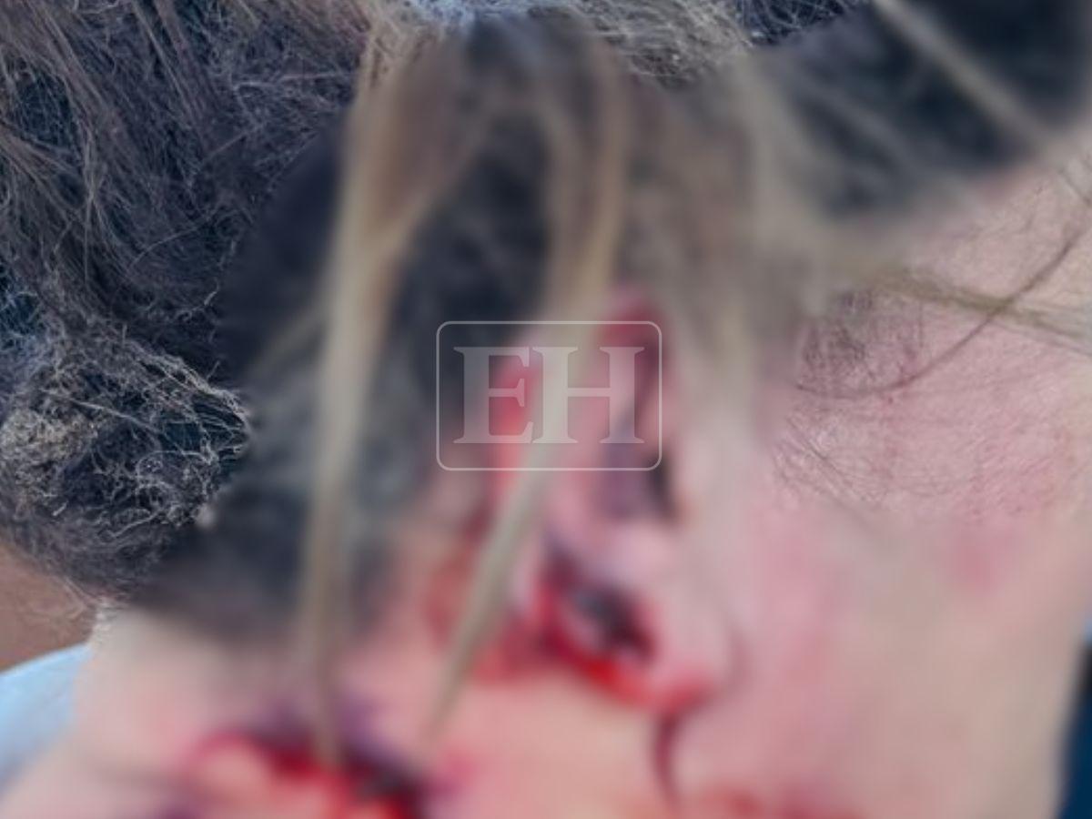 Con heridas en la espalda y cabello quemado: así quedó la diputada Gladis tras ataque con explosivo