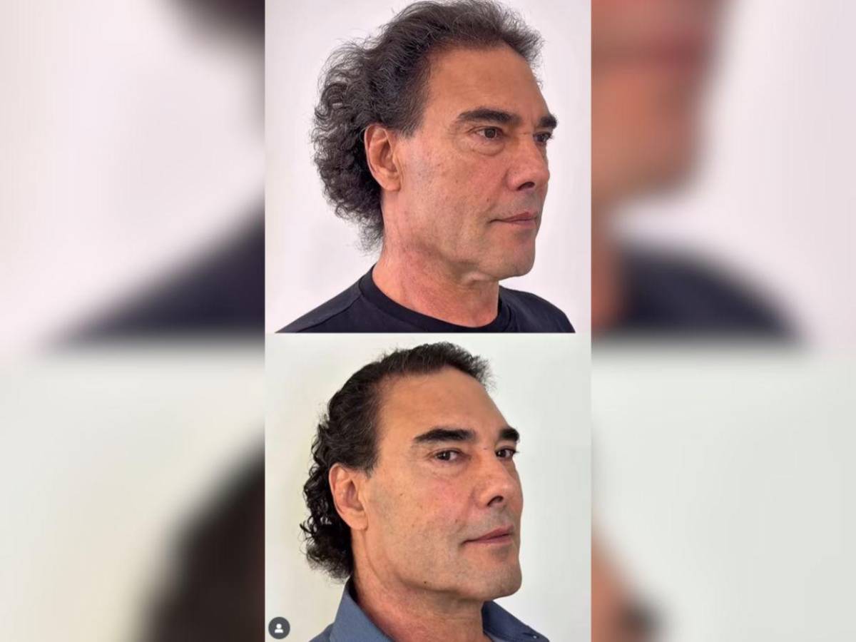 Así luce Eduardo Yáñez tras su procedimiento de rejuvenecimiento