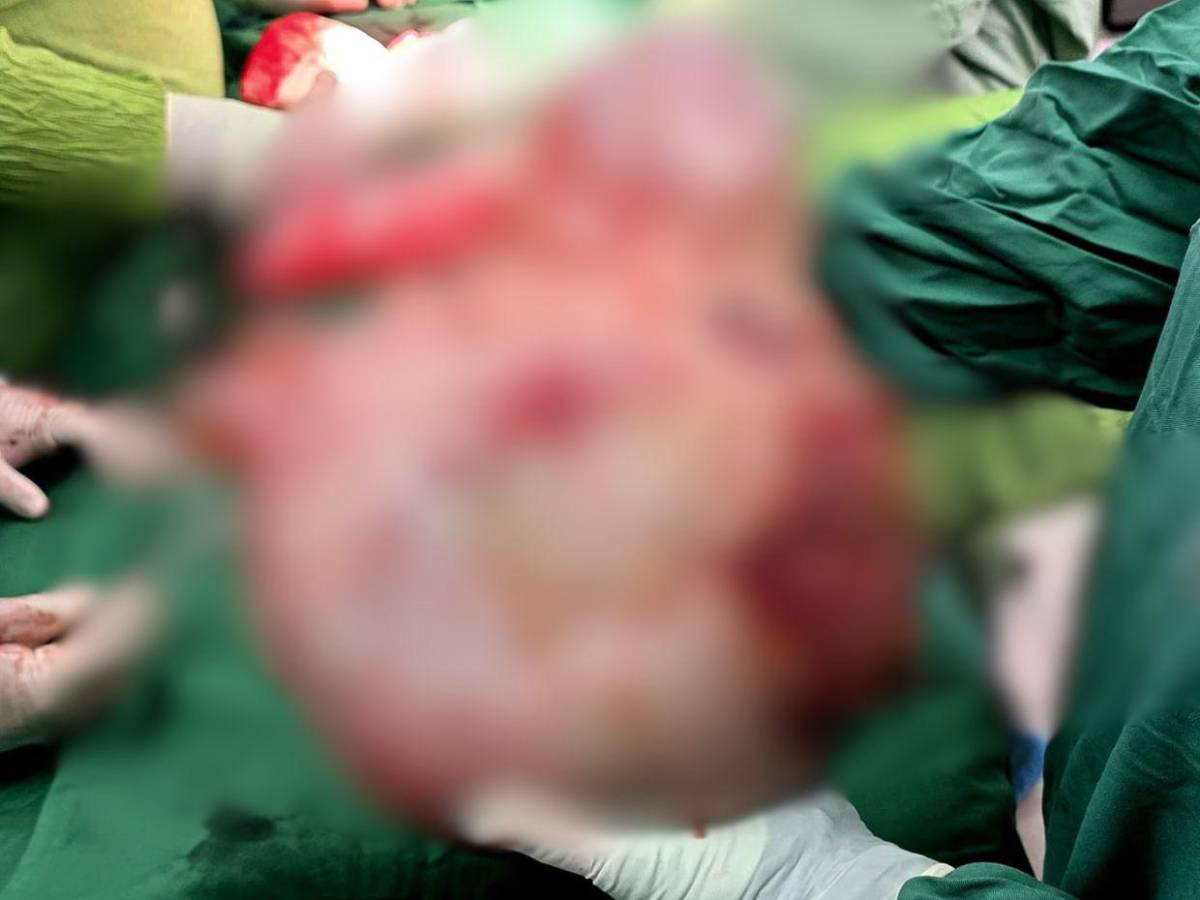 Le extirparon un quiste de ovario que pesaba 20 libras: el caso de una mujer de 64 años en el HE
