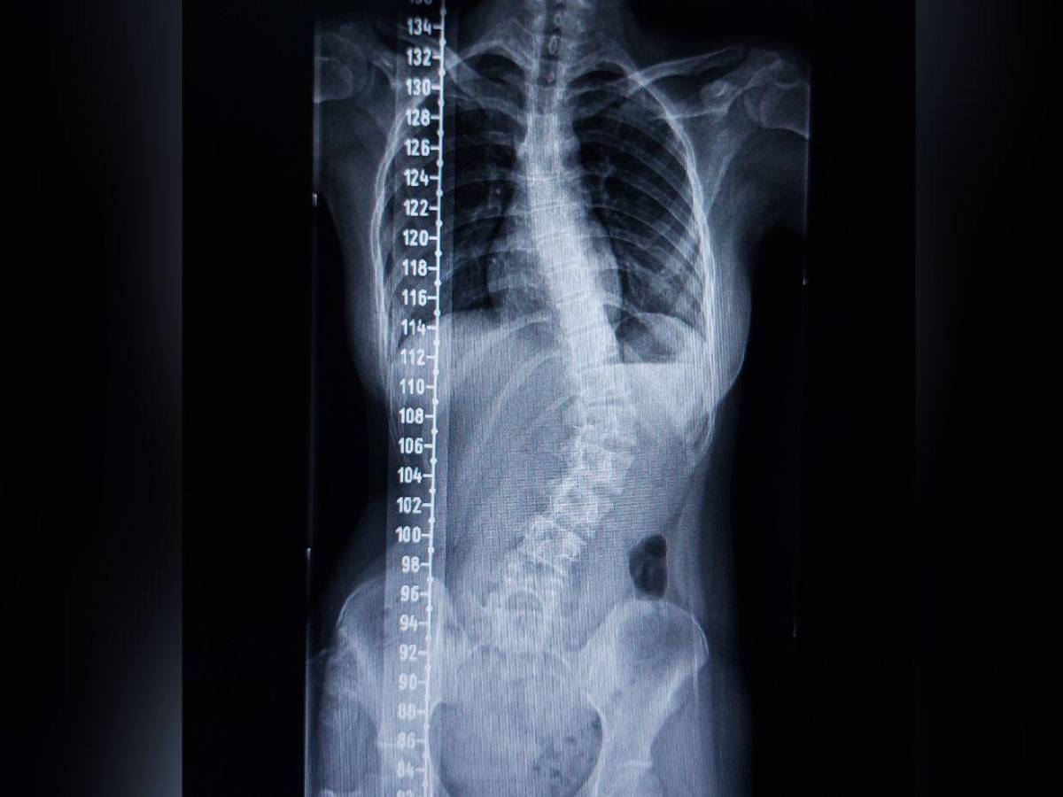 Las lesiones de espalda más comunes y cómo prevenirlas