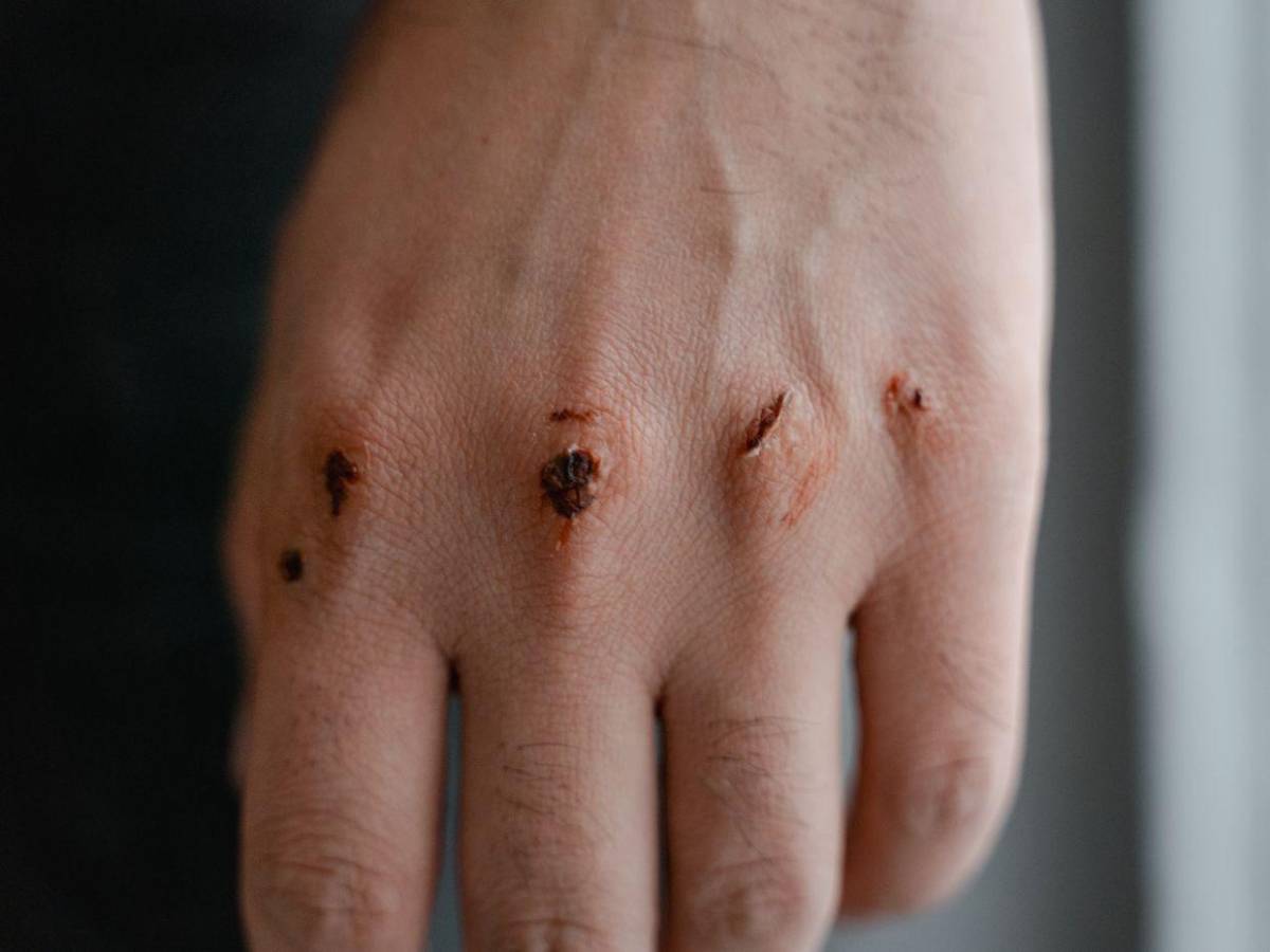 Devorador de hombres, así invade y prolifera en heridas humanas el gusano barrenador