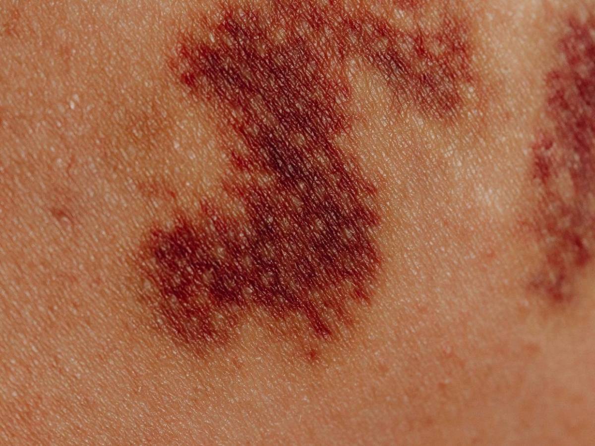 ¿Cuáles son los síntomas de la enfermedad del gusano barrenador en humanos?