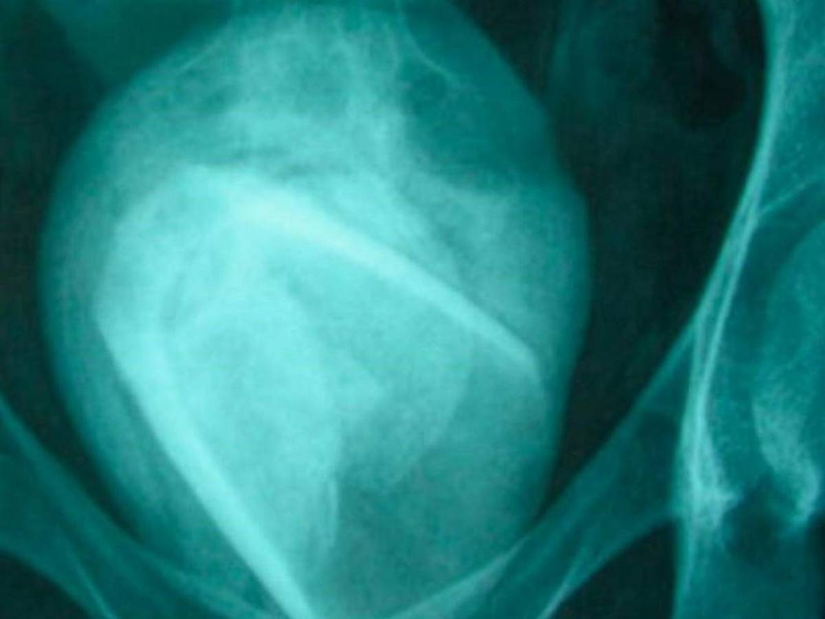 Hallan un vaso de vidrio en la vejiga de una mujer