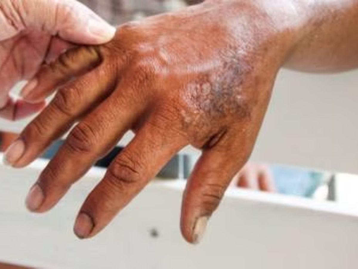 Más de 300 casos de lepra mantienen en alerta a México