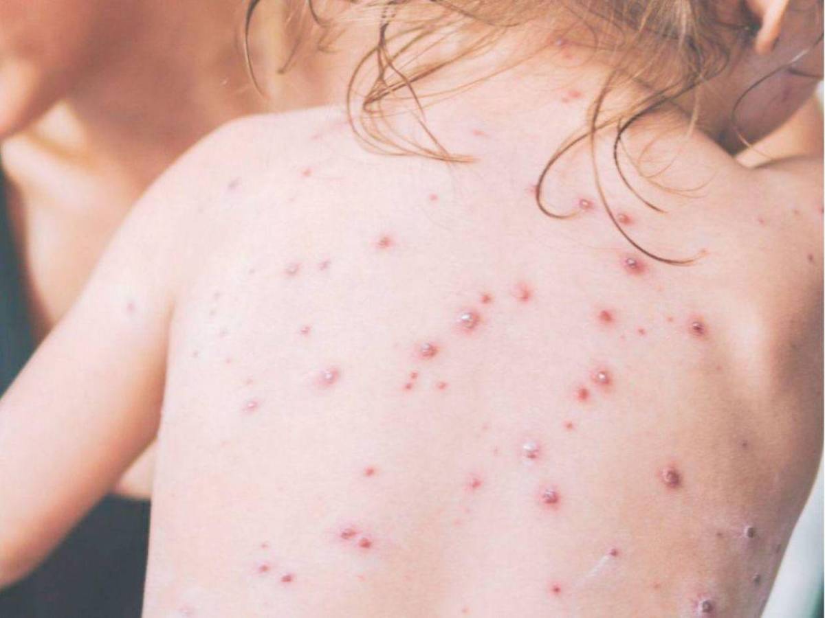 ¿Cuáles son los síntomas del sarampión, la enfermedad que pone en alerta a Honduras?