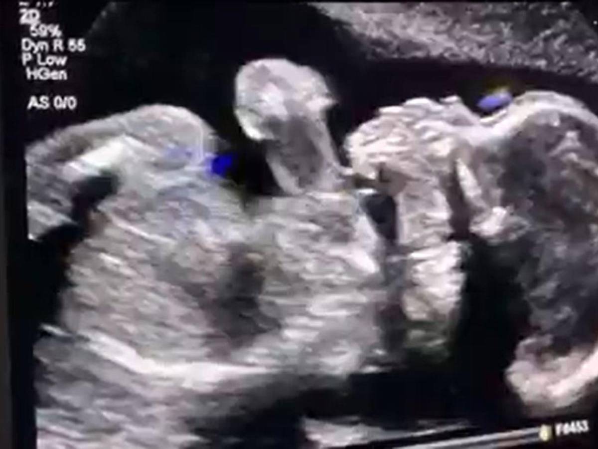 Caso de Adriana Smith: tiene muerte cerebral y no la desconectan por estar embarazada