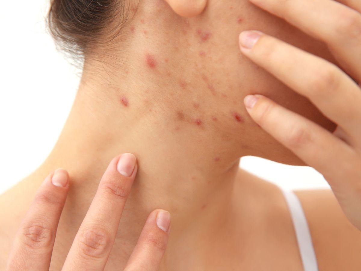 El acné en cara, tórax o espalda también ayuda a identificar el síndrome.