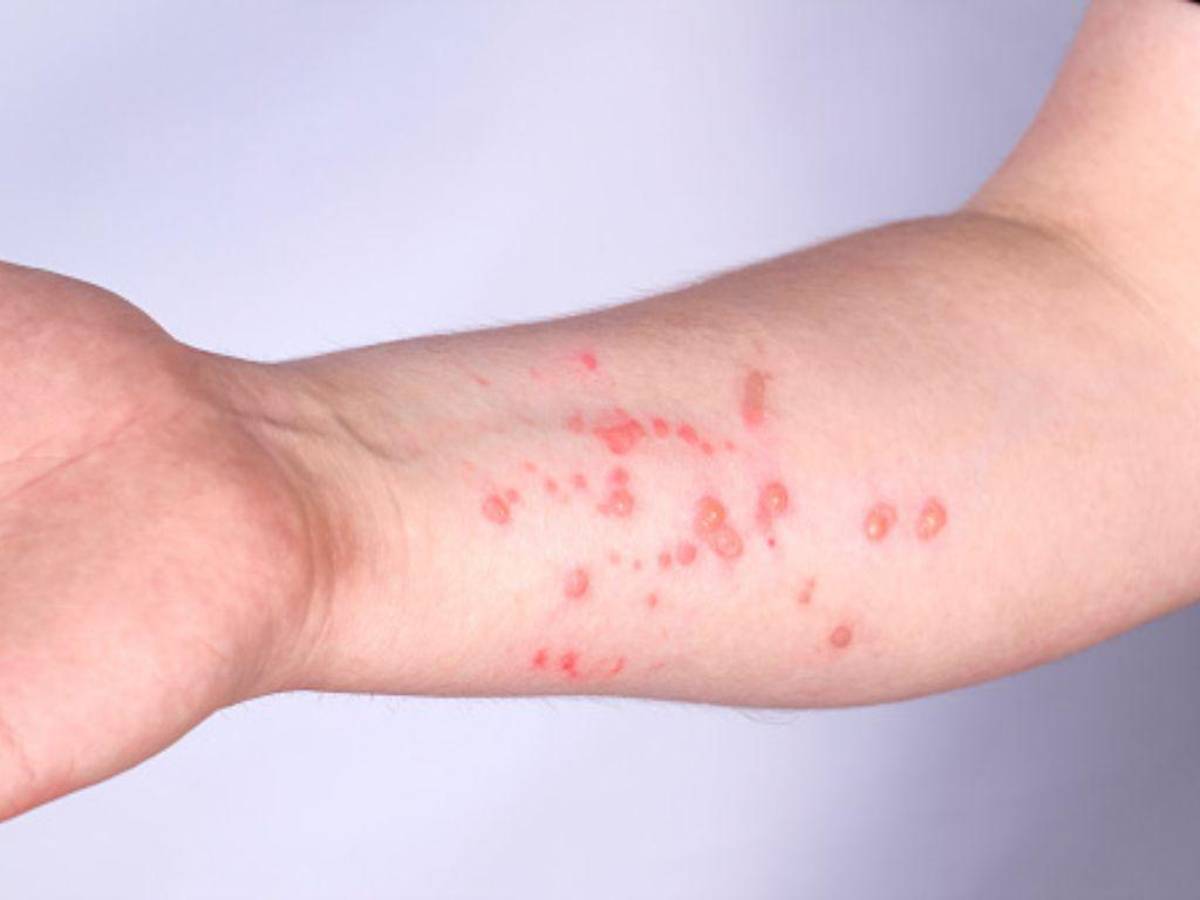 La OMS activa su máximo nivel de alerta por la viruela del mono