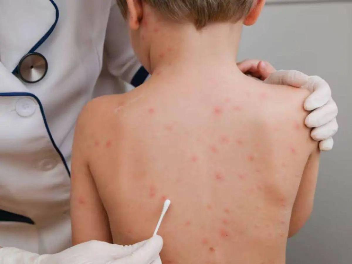¿Cómo saber si tienes sarampión? Estos son los síntomas de alerta
