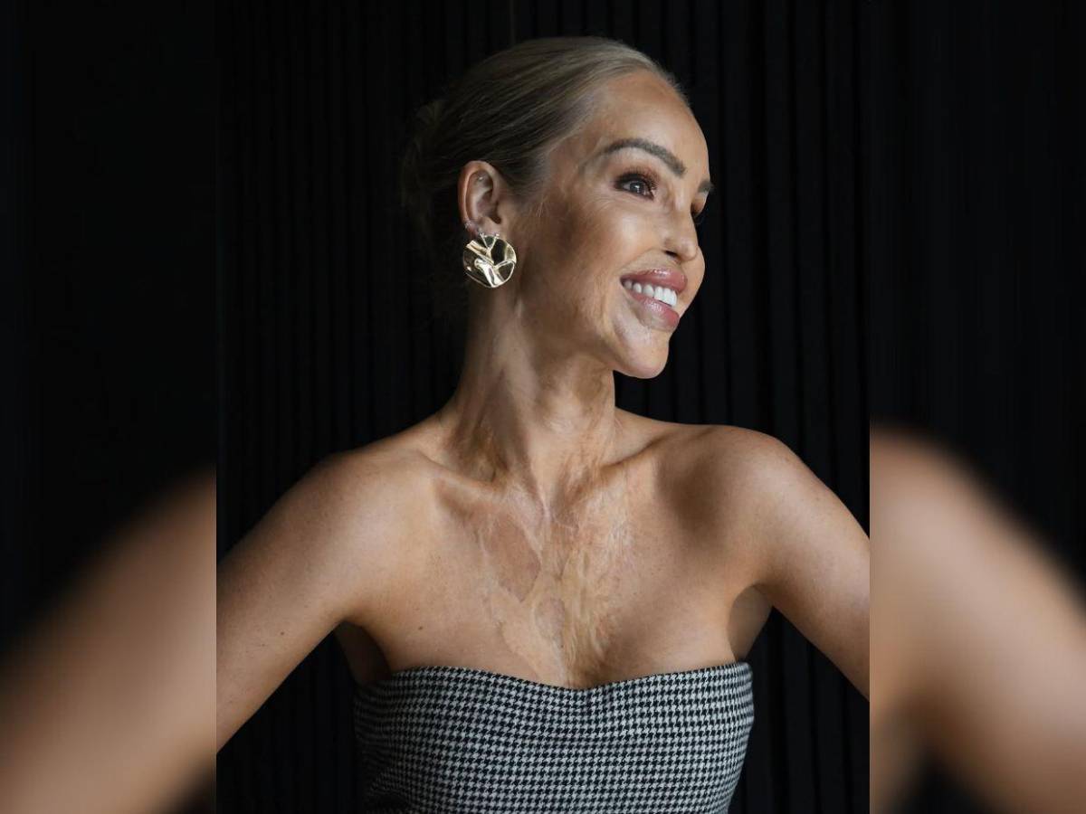 ¿Qué ha sido de Katie Piper, la presentadora a la que le tiraron ácido en la cara?