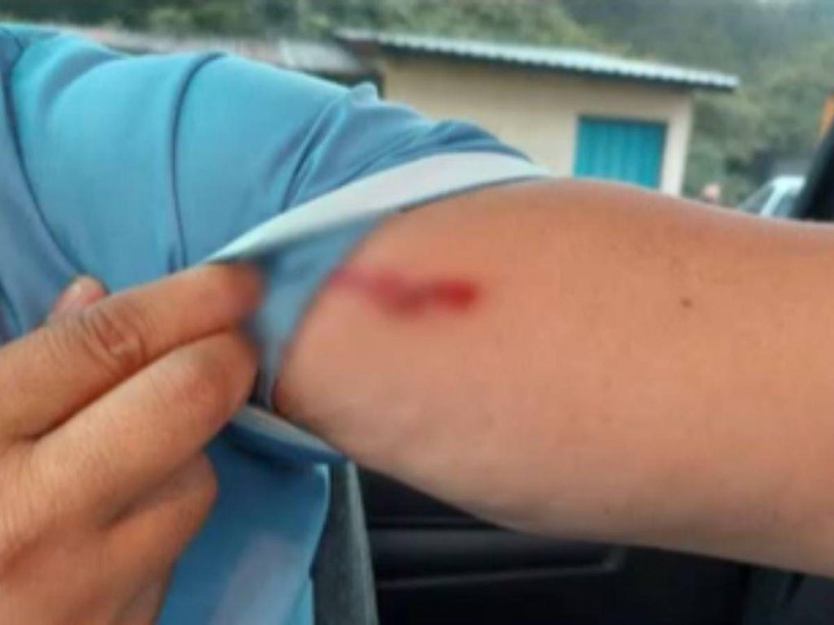 Un pasajero muestra su brazo herido tras el atentado.