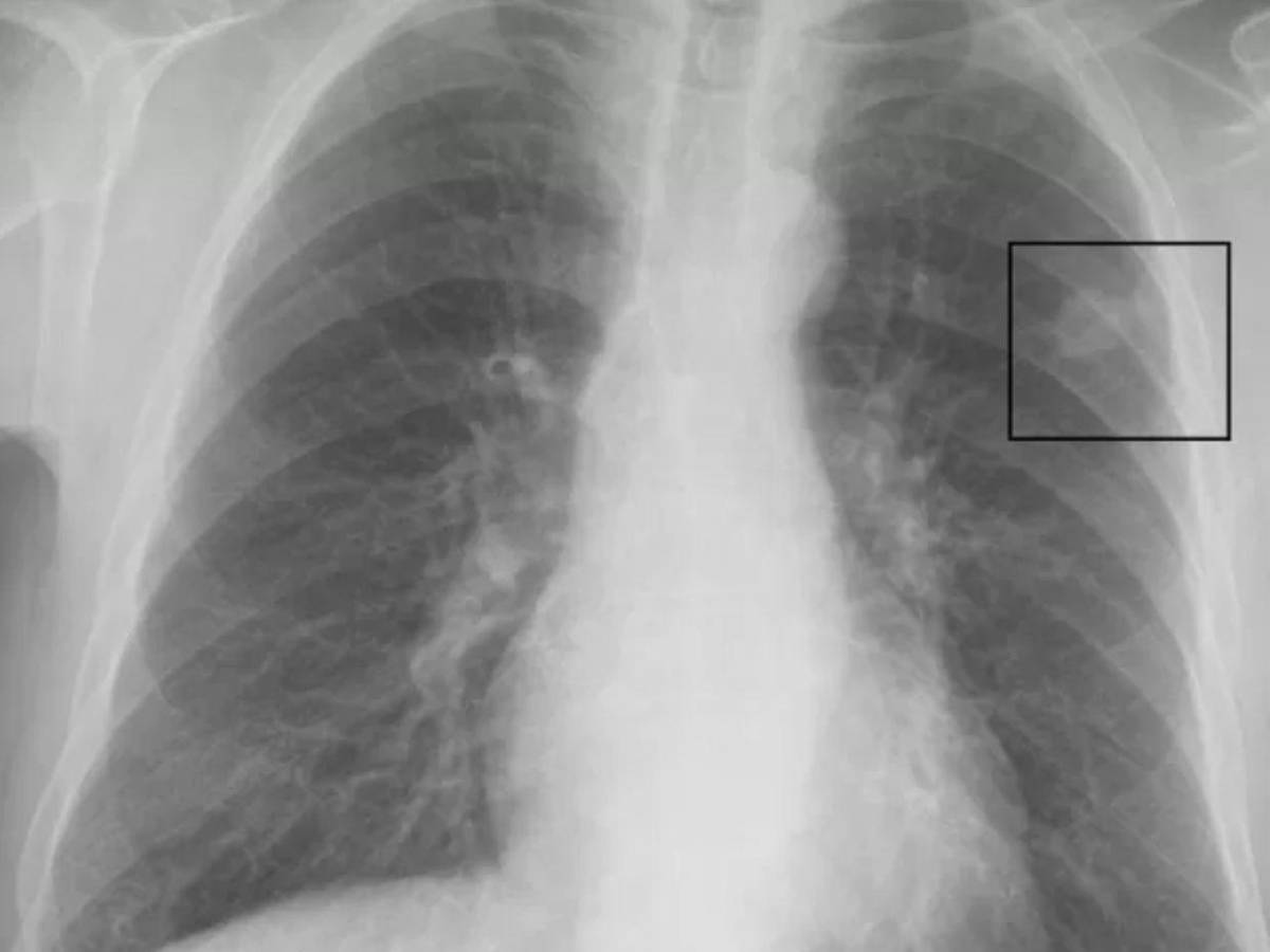 ¿Qué es un nódulo pulmonar, el diagnóstico por el que operarán al papa León XIV?