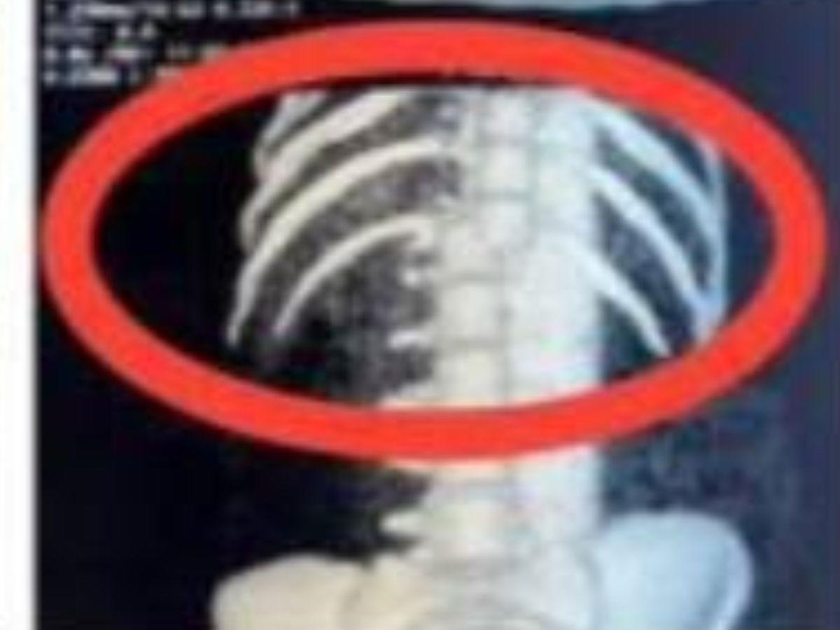 Tiene una hemorragia pulmonar: Nelsy López, la joven que se cayó de la rueda de Chicago en Copán