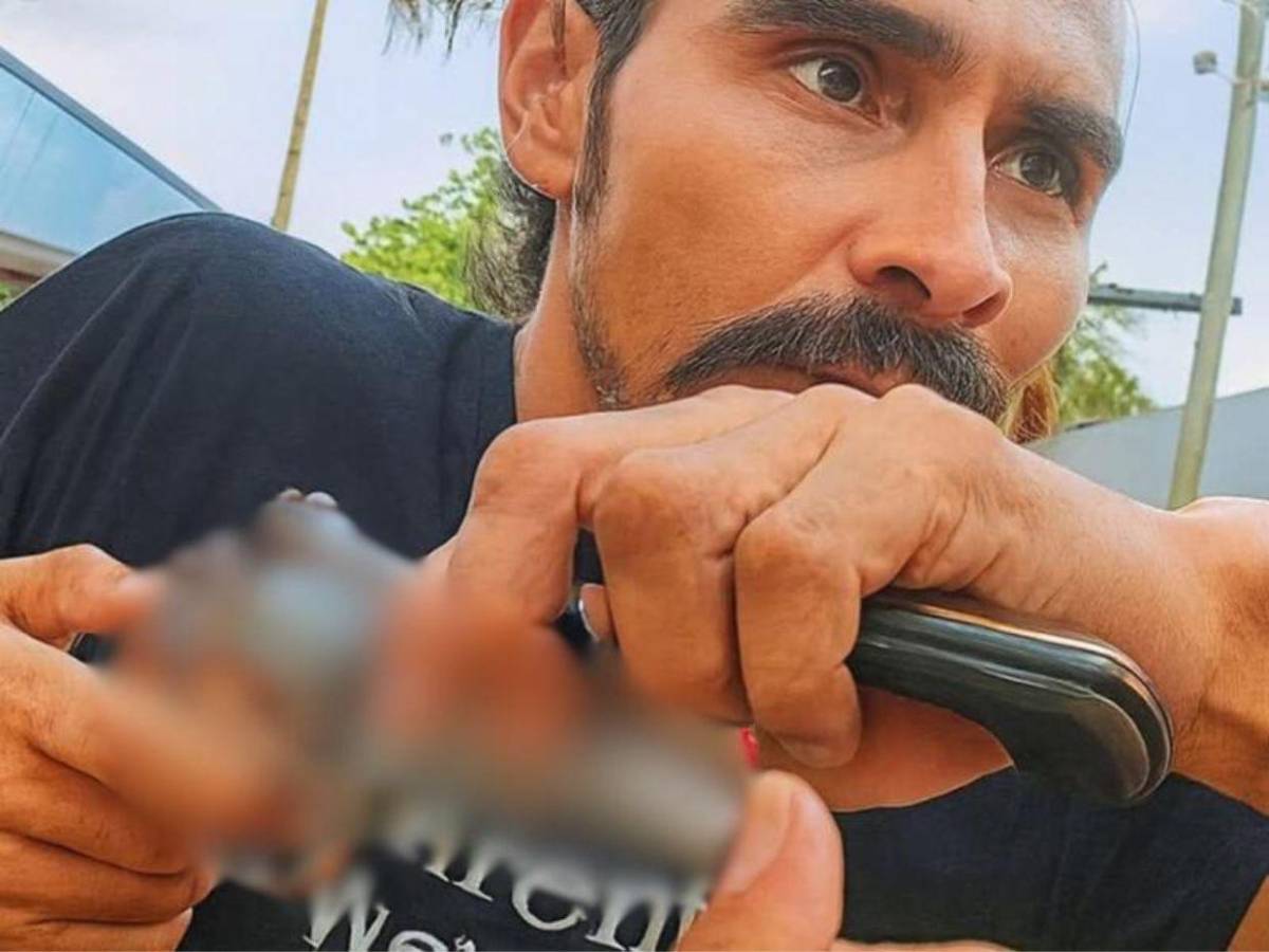 Delivery herido por 'El Burro': Me dijeron que me quedaría con la bala de recuerdo en el Catarino Rivas