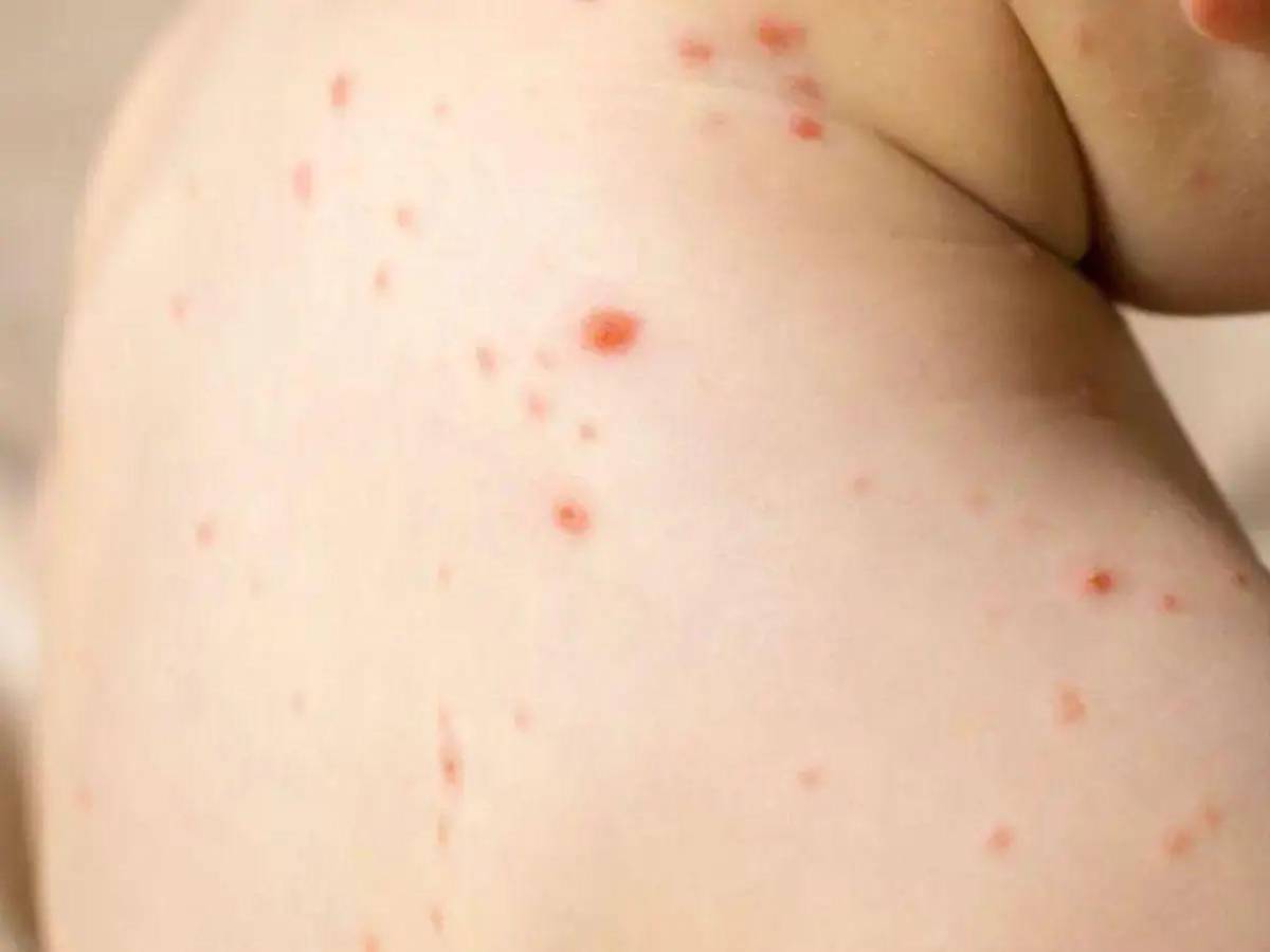 ¿Cómo saber si tienes sarampión? Estos son los síntomas de alerta