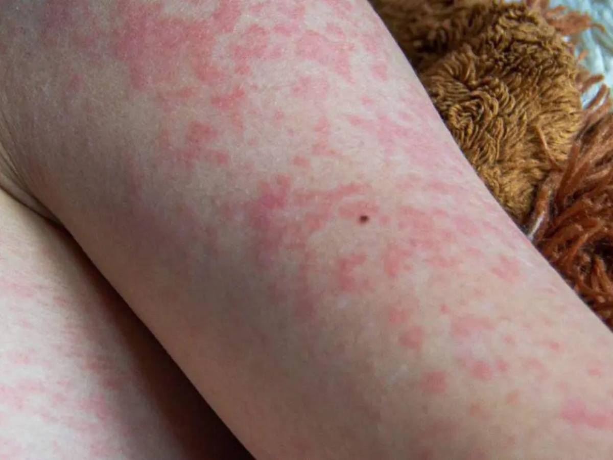¿Cómo saber si tienes sarampión? Estos son los síntomas de alerta