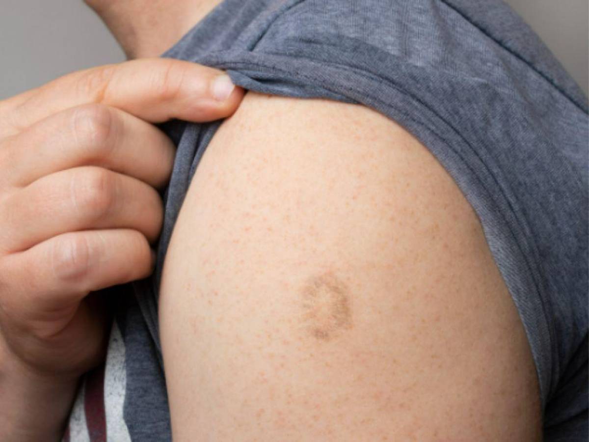 Las personas con esta cicatriz de vacuna en el brazo podrían estar inmunes a la viruela del mono