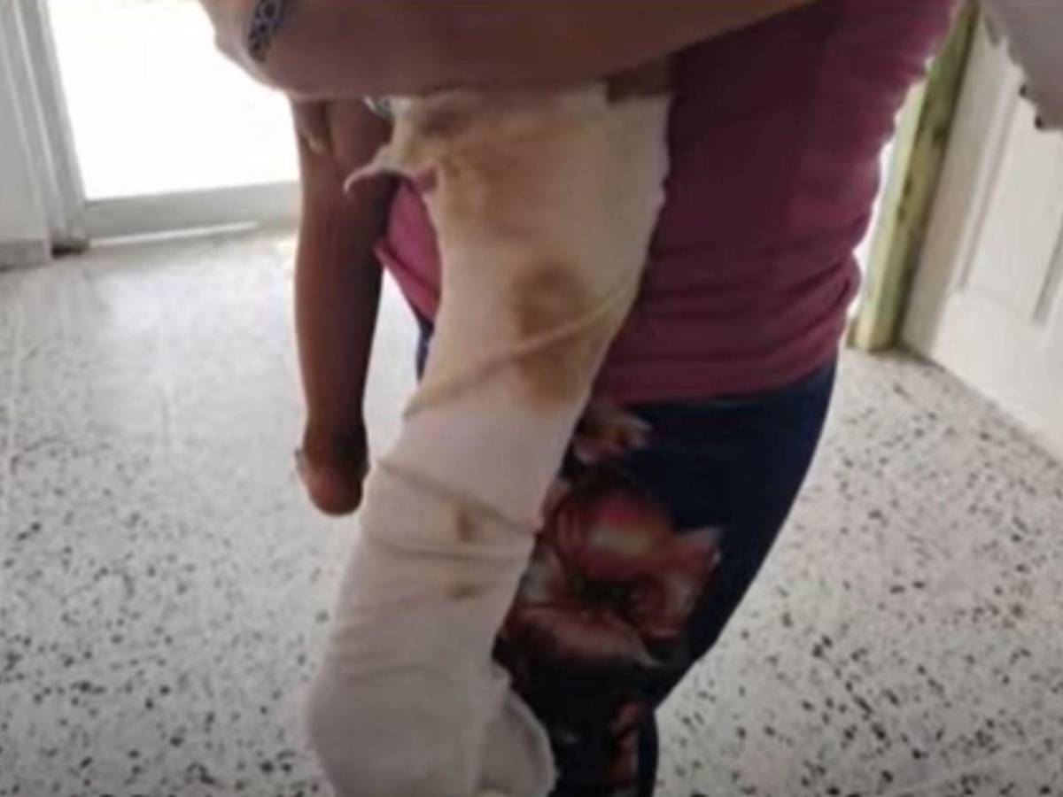 Él me lo quemó, por celos, denuncia madre de menor agredido por su pareja