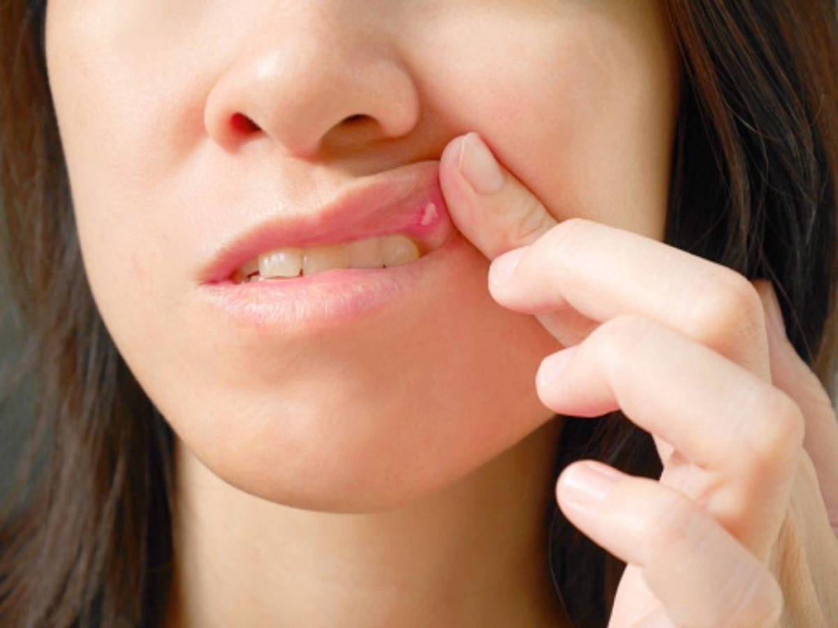 Estas pequeña úlceras suelen aparecer en las zonas blandas de la boca.