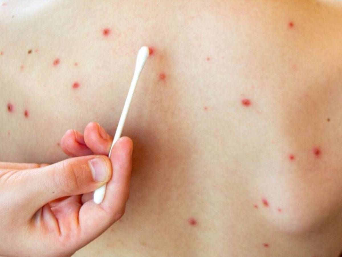 ¿Cómo saber si tienes sarampión? Estos son los síntomas de alerta