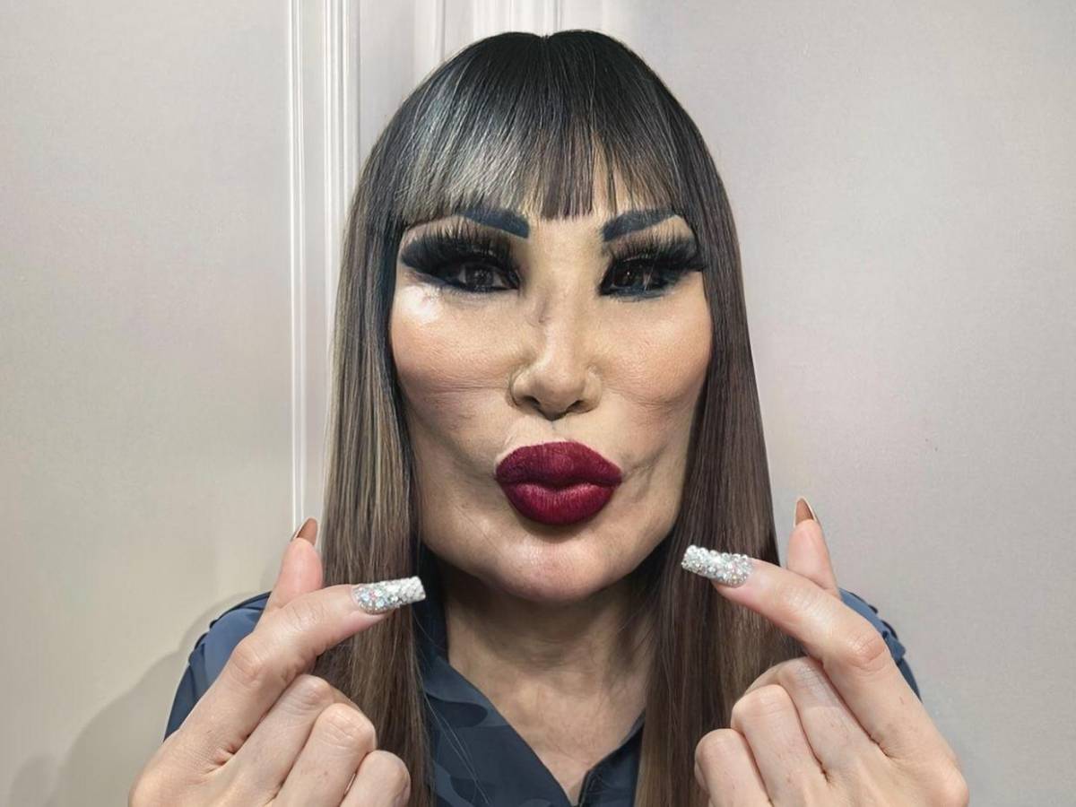 Lyn May y el error estético que deformó su rostro