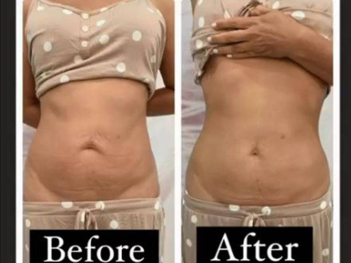 This is the before and after of Adamari López's abdomen.