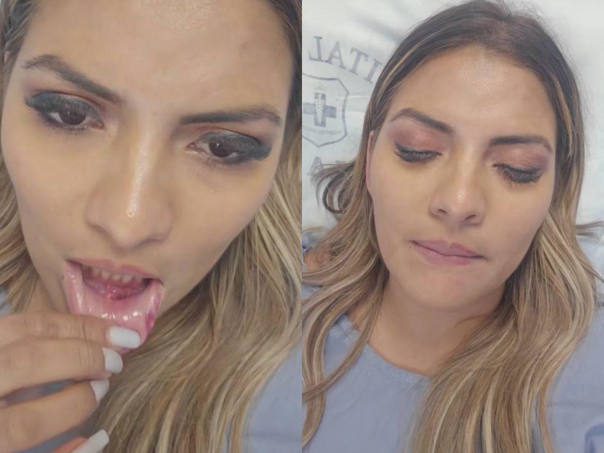 Saraí Espinal, hospitalizada tras sufrir un accidente de tránsito: Me van a suturar el labio Saraí Espinal, hospitalizada tras sufrir un accidente de tránsito: Me van a suturar el labio