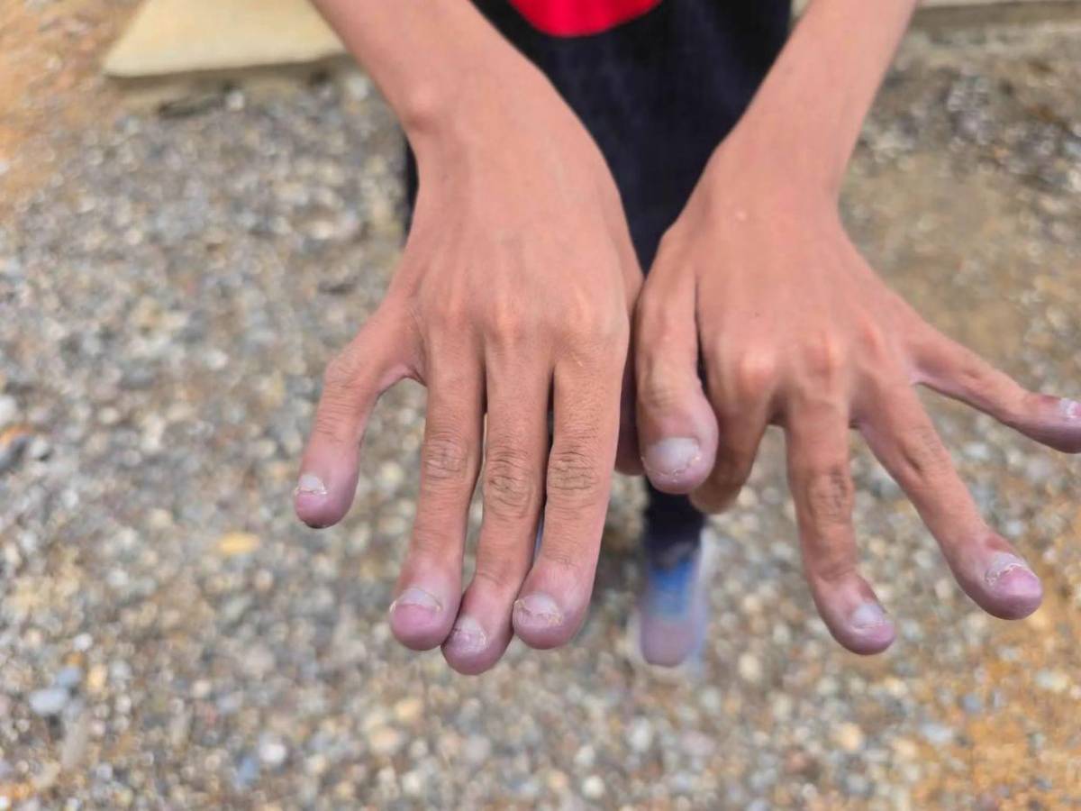 Josué, el niño con el corazón en el lado derecho y cardiopatía; El Salvador  extenderá ayuda