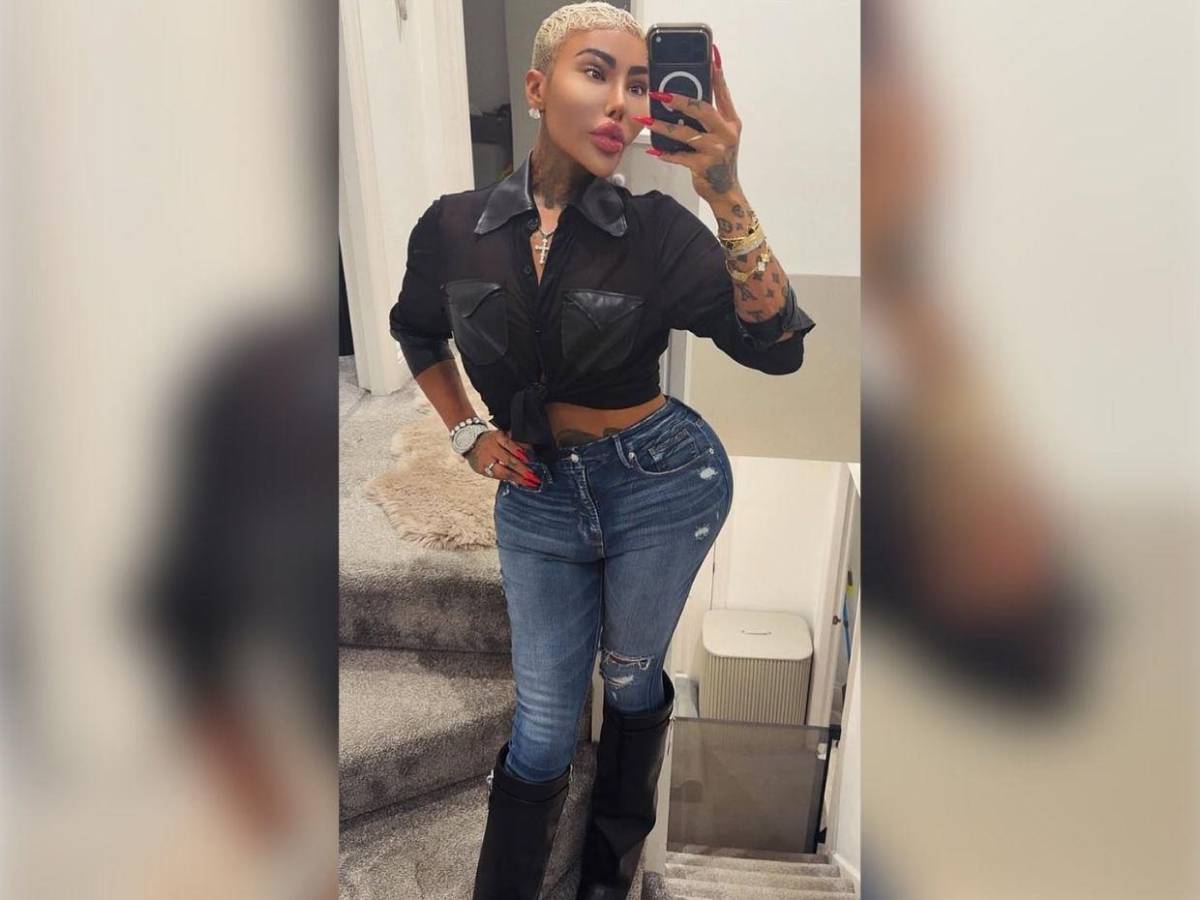 Muere el rey de los labios tras presuntas complicaciones por cirugía estética