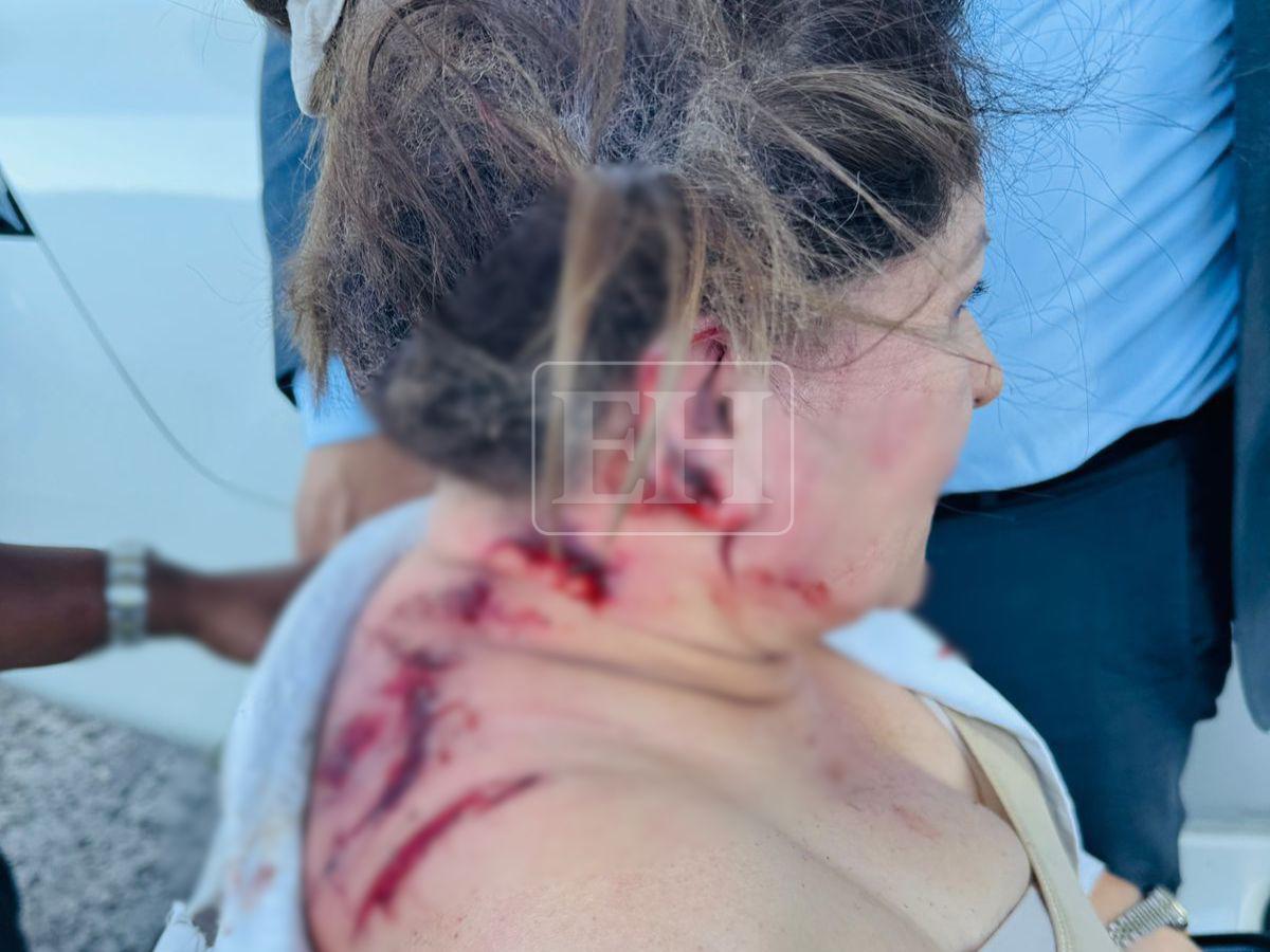 Con heridas en la espalda y cabello quemado: así quedó la diputada Gladis tras ataque con explosivo