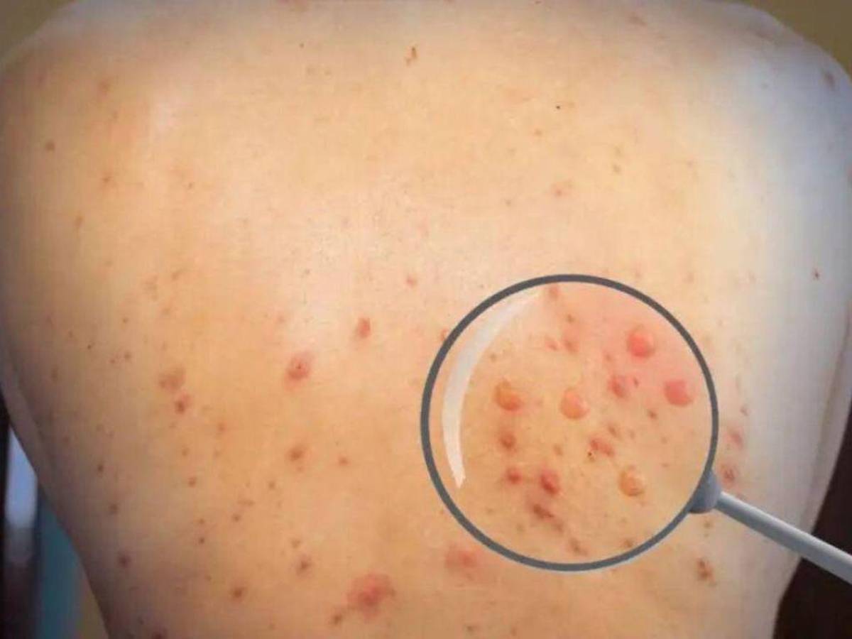 Estadounidense con viruela del mono se fuga de hospital en México