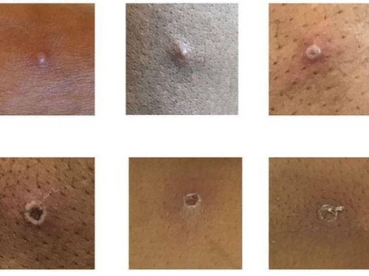 La viruela del mono se diferencia de otras enfermedades porque estas erupciones suelen iniciar entre el primer y tercer día desde que comienza la fiebre, este sarpullido puede ser plano o ligeramente elevado, además de contener líquido transparente o amarillo para luego formar costras que se secan y se caen.