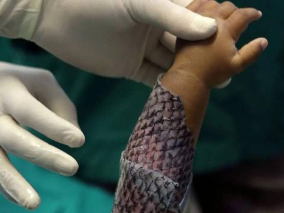¿La piel de tilapia cura cicatrices por quemaduras? Esto revela estudio brasileño