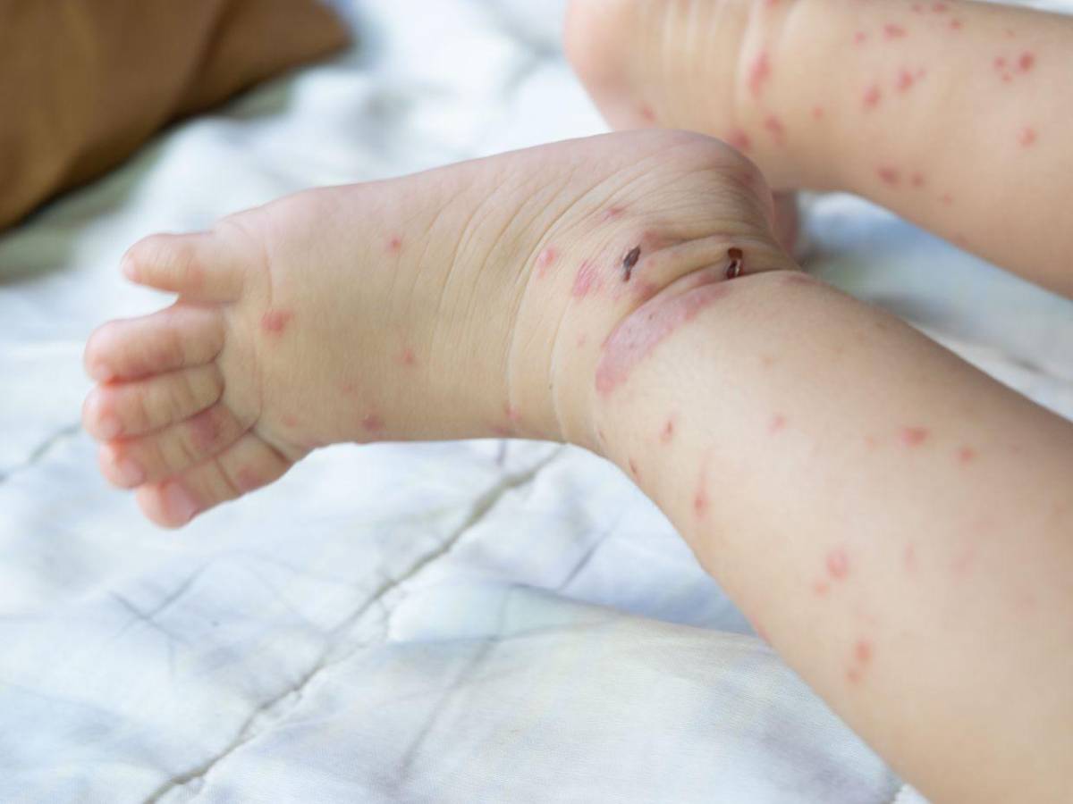 Brote de sarampión en Carolina del Sur deja a 139 niños en cuarentena