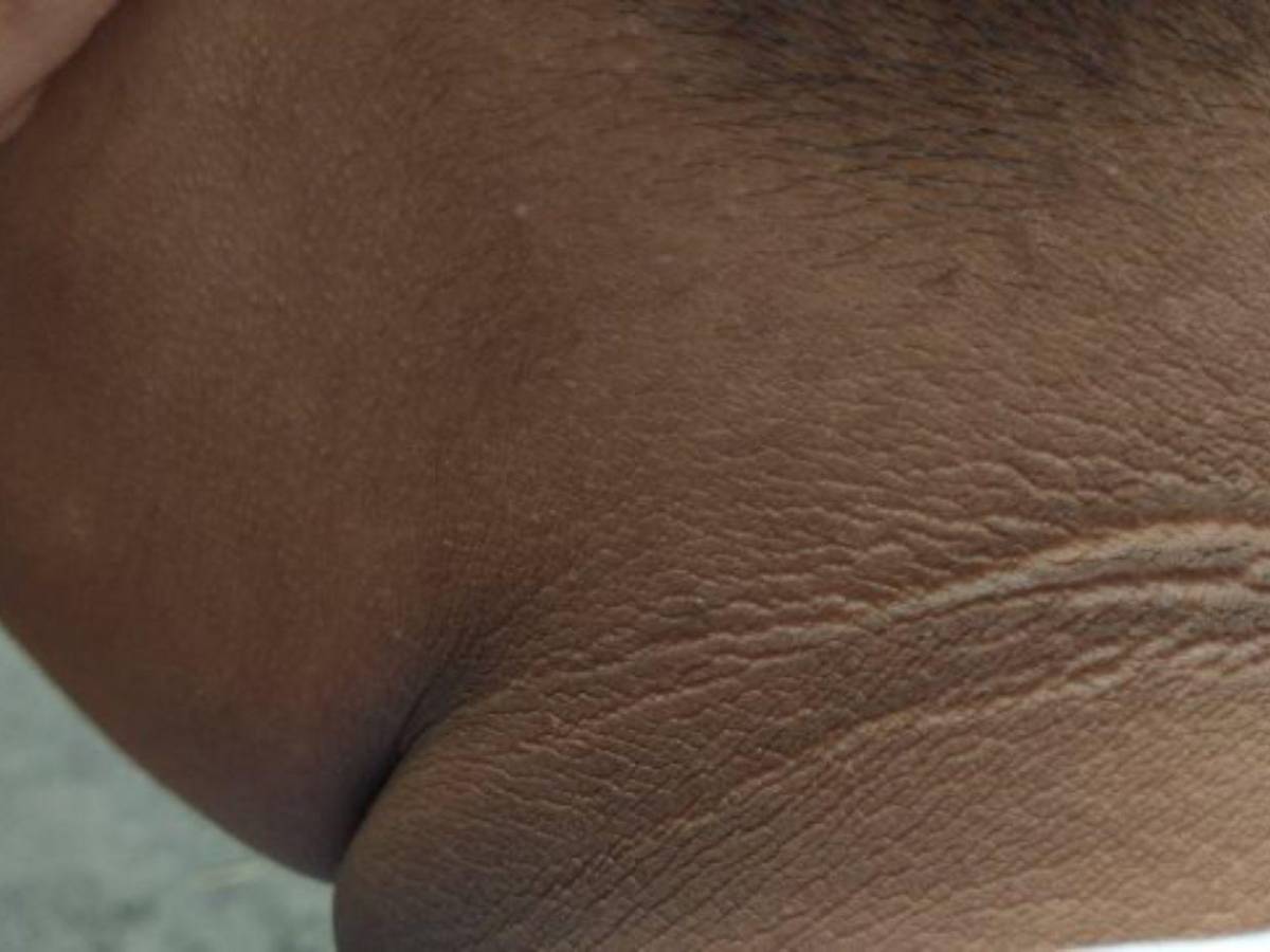 Visión borrosa y oscurecimiento de la piel: los síntomas de la diabetes mellitus que la mayoría ignora