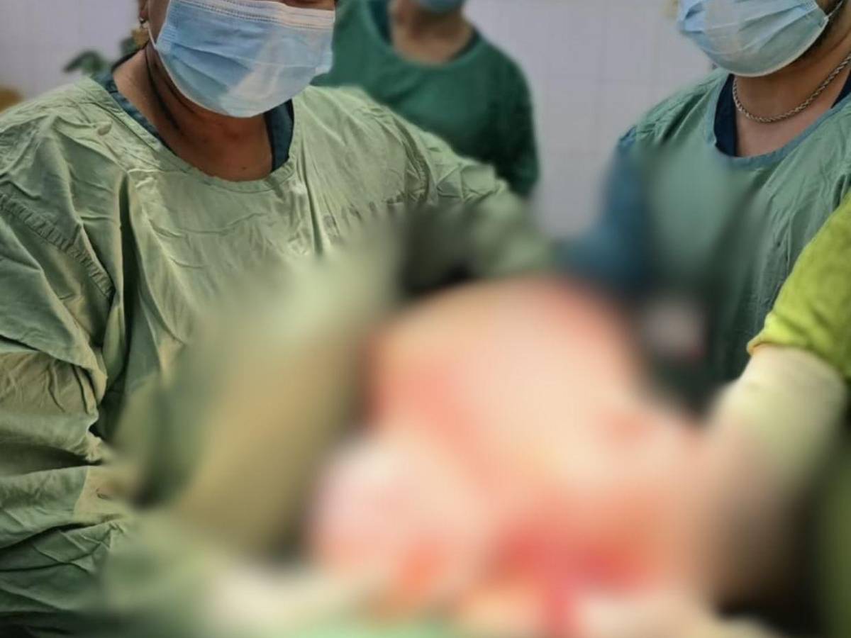 Le extirparon un quiste de ovario que pesaba 20 libras: el caso de una mujer de 64 años en el HE