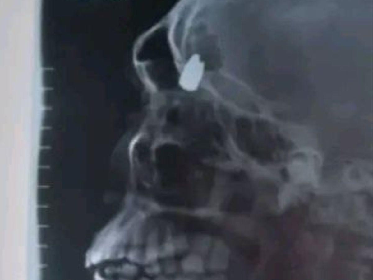 Esta es la radiografía del menor de 14 años que muestra la bala que quedó en su cabeza.