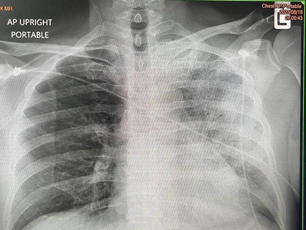 Legionelosis: Síntomas y tratamiento de la enfermedad que preocupa a Nueva York
