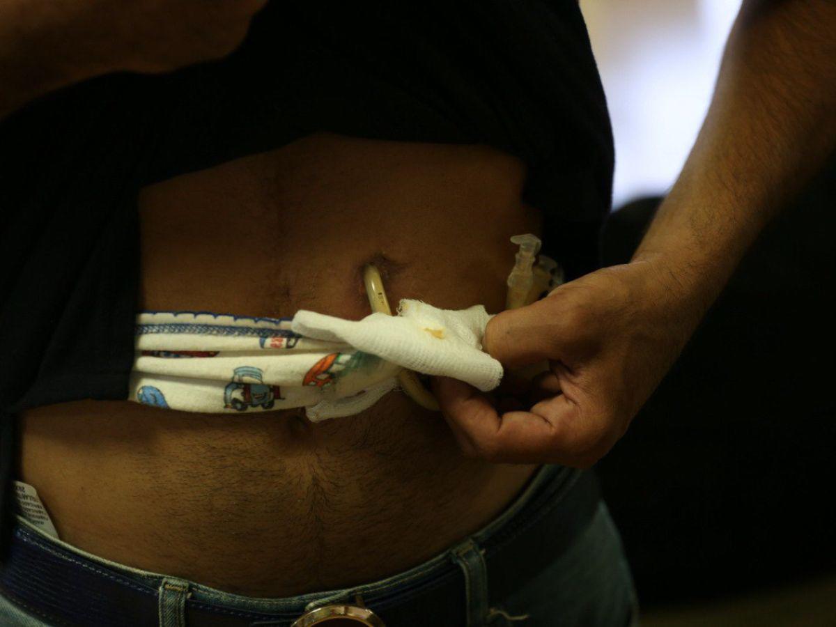 “Siempre tengo que tener a mano mi jeringa para poder alimentarme por medio de una sonda que esta en mi cuerpo sin eso no sobrevivo”, relató.