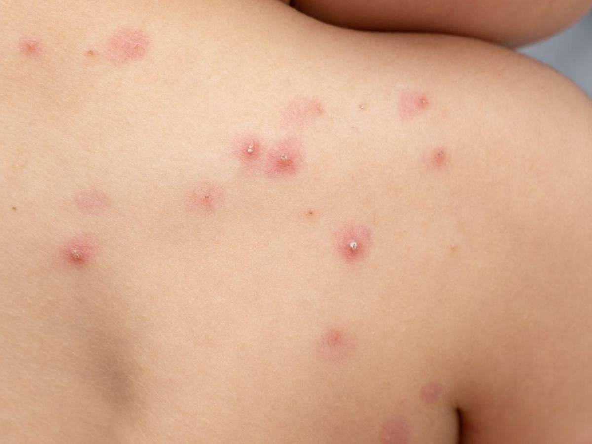 Transmisión de viruela del mono entre personas “puede detenerse en países no endémicos” (OMS)