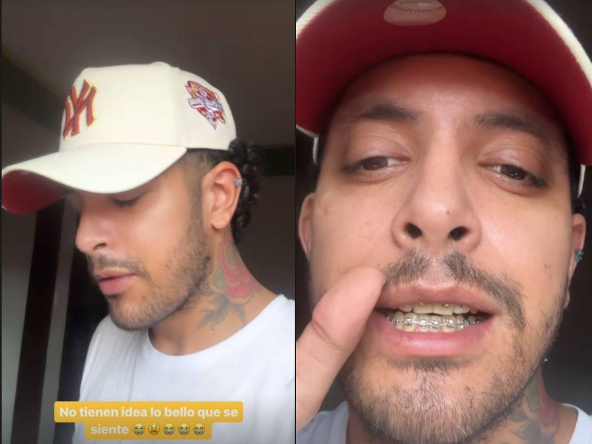 El antes y después de Fancony tras cirugía ortognática: “Soy más feliz que nunca”