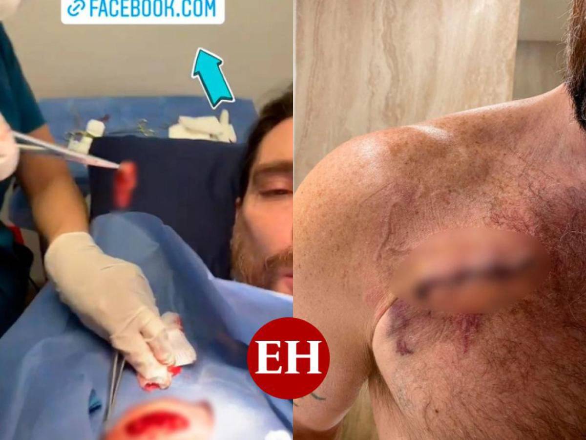 The actor shared these images of his operation.