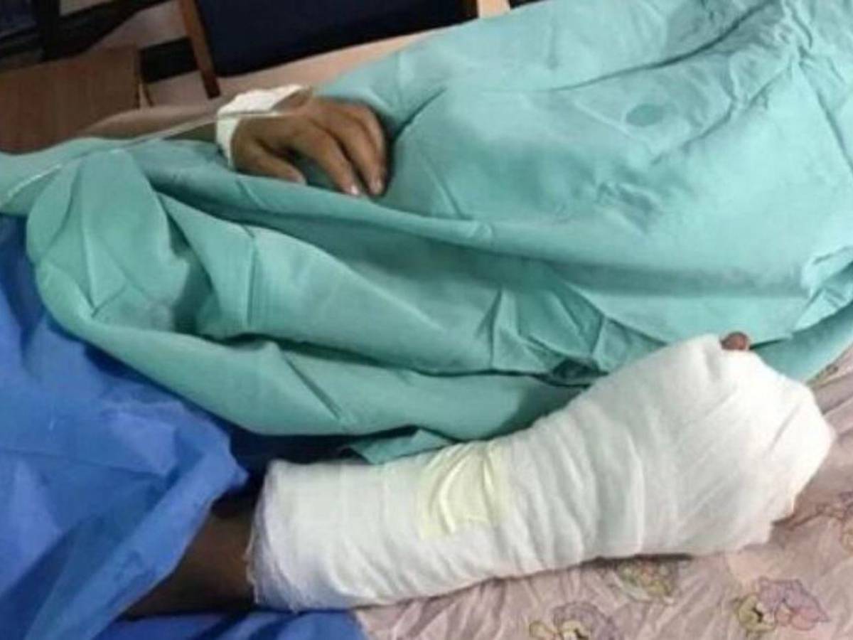 Más de 10 quemados por pólvora se registraron durante las fiestas de Fin de Año