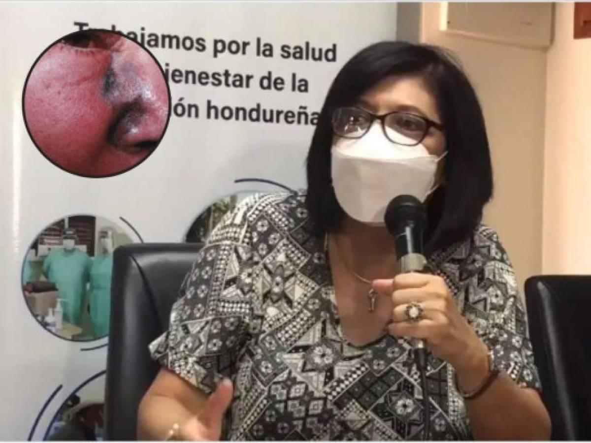 El hongo negro existe en Honduras desde hace 40 años: Secretaría de Salud