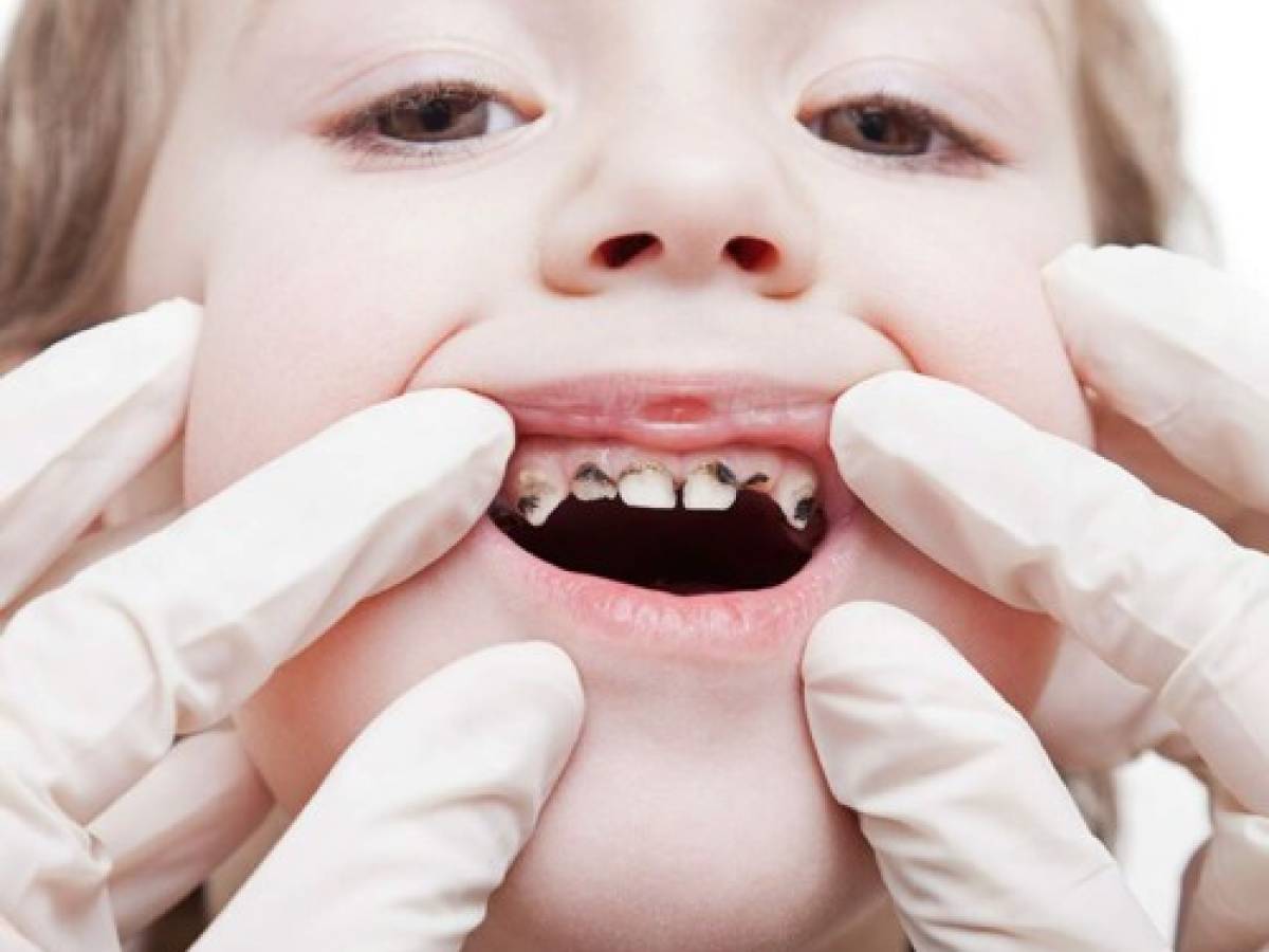 ¿Qué enfermedades pueden ocasionar las caries dentales?